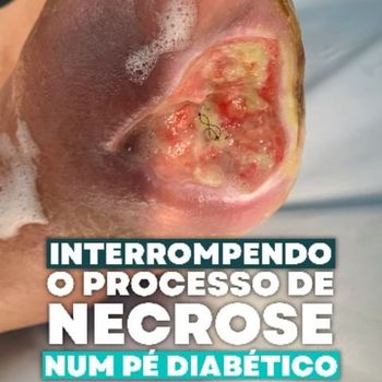 Interrompendo o processo de necrose num Pé Diabético, evitando amputações seriadas. /interrompendo-o-processo-de-necrose-num-pe-diabetico-evitando-amputacoes-seriadas