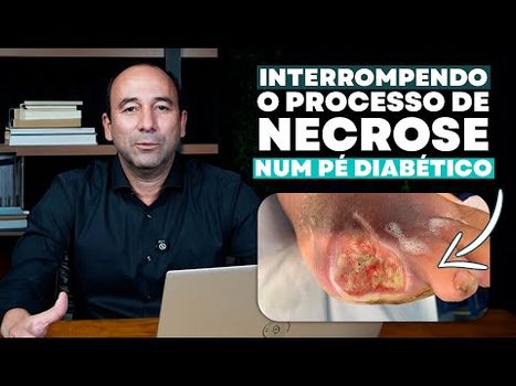 Técnica de Figueiredo interrompendo o processo de necrose num Pé Diabético. /tecnica-de-figueiredo-interrompendo-o-processo-de-necrose-num-pe-diabetico