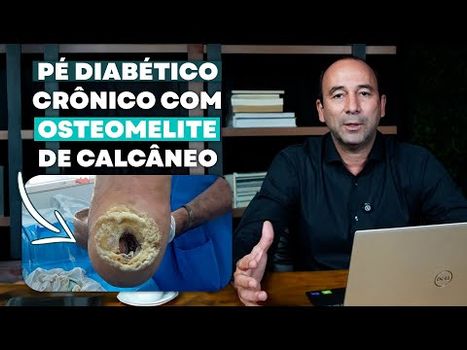 Técnica de Figueiredo - PÉ DIABÉTICO crônico com OSTEOMELITE DE CALCÂNEO /tecnica-de-figueiredo-pe-diabetico-cronico-com-osteomelite-de-calcaneo