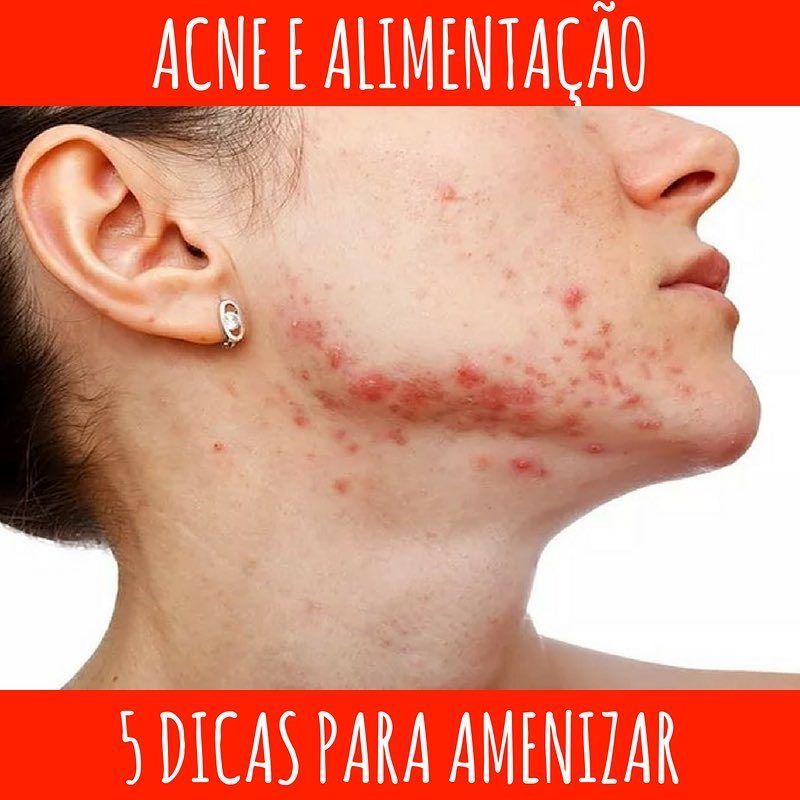 Acne e Alimentação - 2